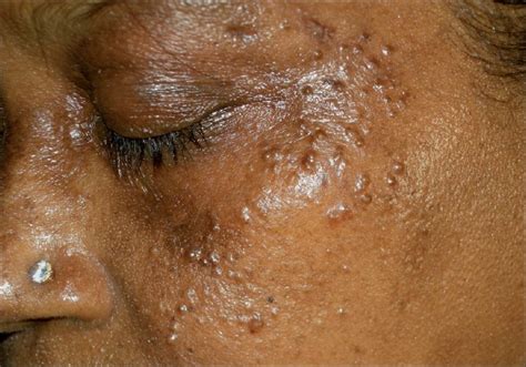 Multiple translucent papules on the face of a middle-aged woman ...