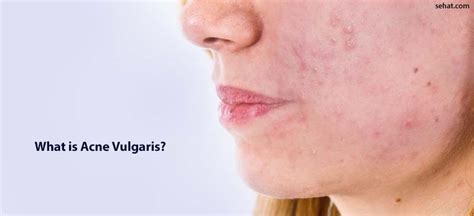 Acne Vulgaris - Definition, Causes, Treatment, Prevention