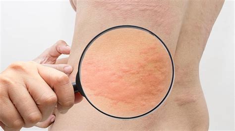 Urticaria Crónica Tratamientos Y Cómo Combatirla Para Paliar Sus Efectos