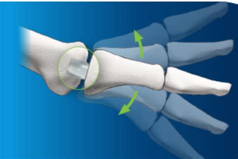 Great Toe Joint Replacement - David Shepherd