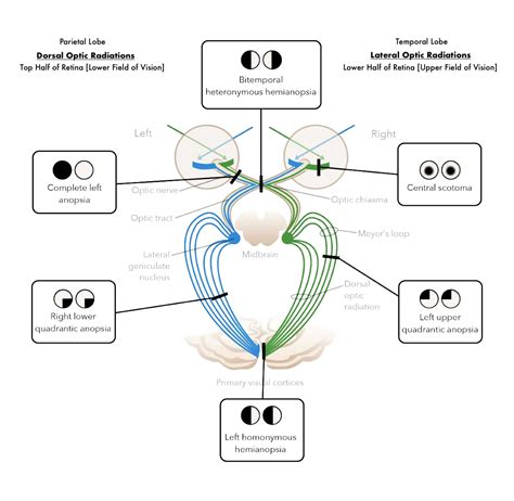 Left Homonymous Hemianopsia Is Described As