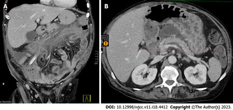 Pancreatitis Panniculitis And Polyarthritis Syndrome A Case Report