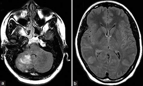 T2 Axial Flair Mri Demonstrating Continuing Hyperintensity Of The Right Download Scientific