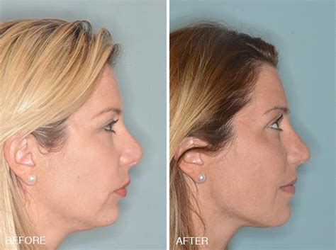 Revision Rhinoplasty Photos Miami Fl Patient 840