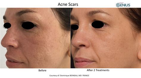 Genius Rf Microneedling Acne Scar Treatment Skin Tightening — Rejuve Medspa Newcastle Near