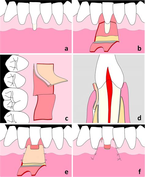 Gingival Recession Diagram