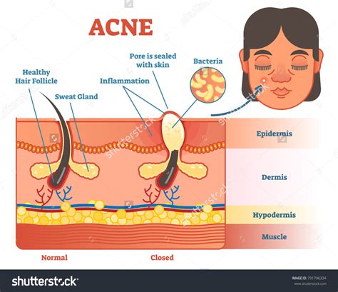 Acne Vector Diagram Illustration Hair Pinple Stock Vector (Royalty Free ...