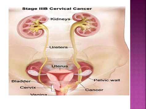 Carcinoma Cervix Ppt