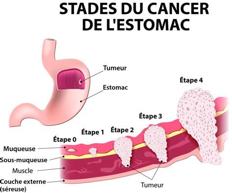 Cancer de l estomac Causes Symptômes et Traitements Information