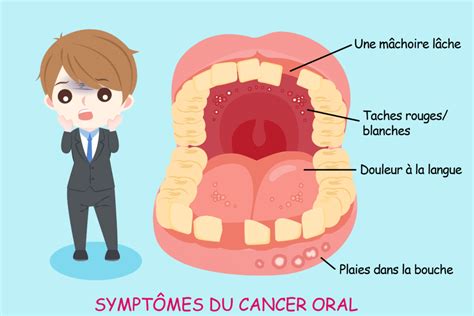 Cancer Buccal Différents Stades Et Gravité Information