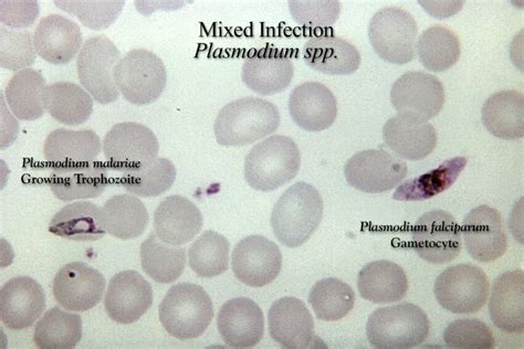 Free Picture Thick Film Micrograph Mixed Falciparum Malariae