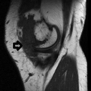 (PDF) Synovial Hemangioma in the Knee: MRI Findings