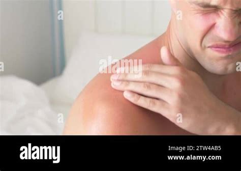 4k A Man Smears His Shoulders Received A Sunburn Gel From Burns A