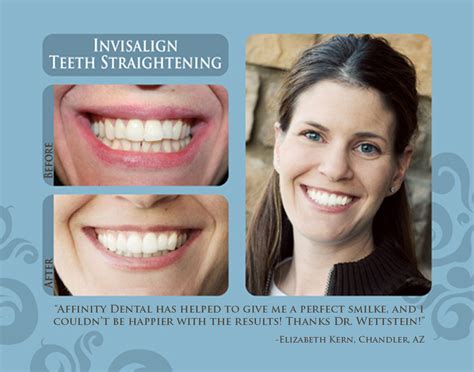 Before And After Picture Of Invisalign Invisalign Teeth