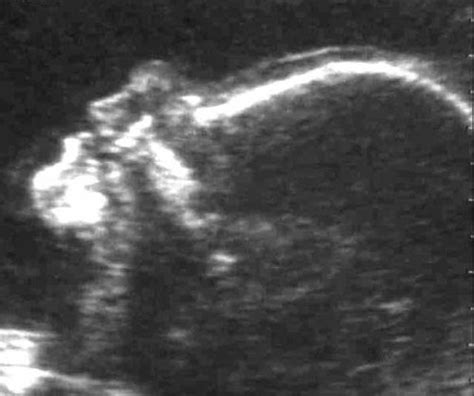 Nasal Bone Hypoplasia In Trisomy At Weeks Gestation Cicero