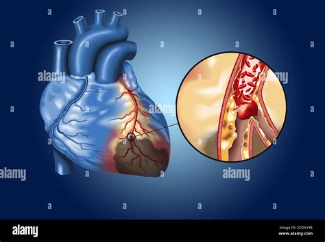 Placa En Arteria Coronaria Co Gulo De Sangre Trombo Que Se Rompe Y