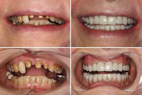 What Is Cosmetic Dentistry Which Procedure To Choose ILAJAK Medical