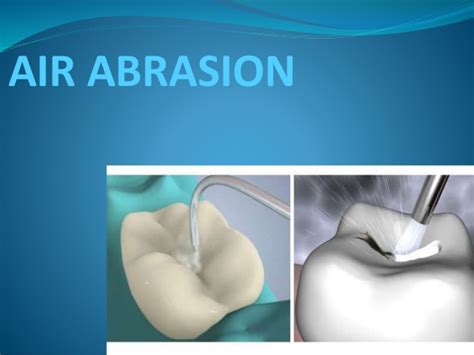 Air Abrasion | Fishers, IN Dentist