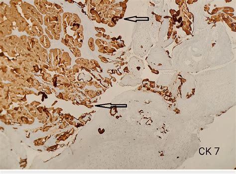 Ihc Staining Showing Positive Immunohistochemical Stain For Ck Ihc