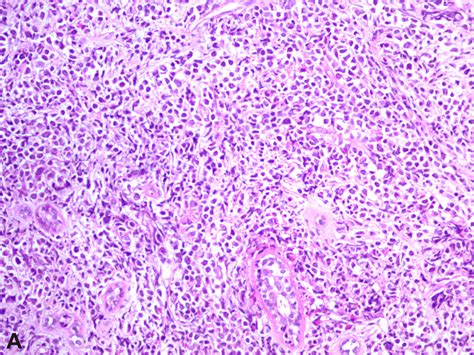 Breast Biopsy A Diffuse Blasts Infiltration B More Mature