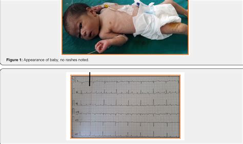 Figure 1 From Report Of Congenital Heart Block And Atrial Septal