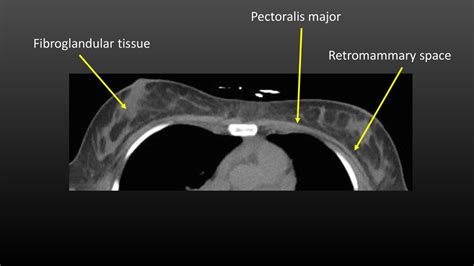 What breast lesions do we find incidentally on CT? - ppt download
