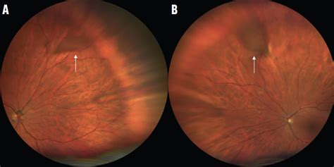 Choroidal Nevus With Red Free Filter