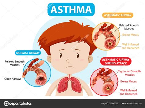 Diagrama Del Asma Con Vía Aérea Normal Ilustración Asmática Vía Vector