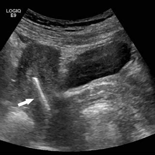 Transvaginal Sagittal Sonogram Demonstrating An Intrauterine Device In