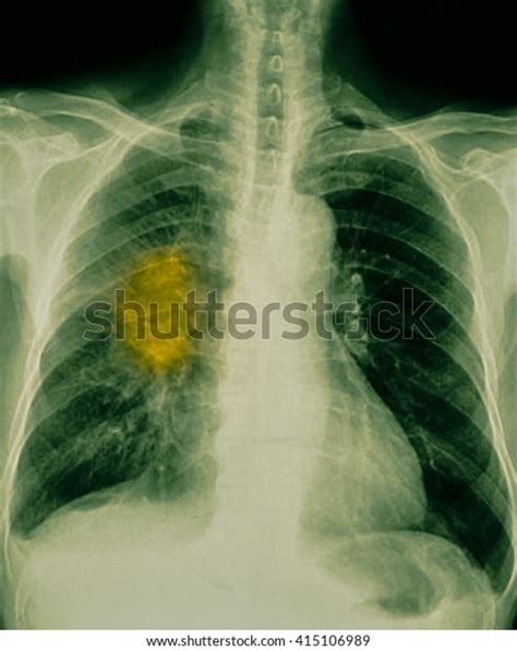 Film Chest X Ray Show Cavity Right Stock Photo Shutterstock