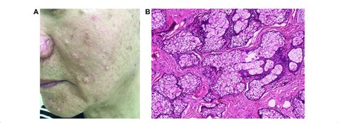 Skin Colored Papules Represent Hyperplastic Sebaceous Glands Download Scientific Diagram