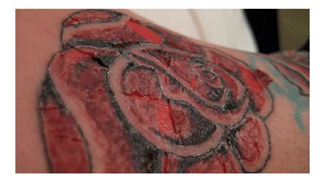 Update 59 Skin Rejecting Tattoo Ink Latest In Cdgdbentre