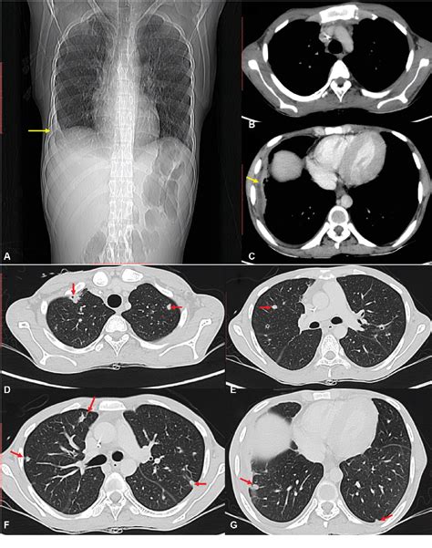 Figure 14 From Imaging Approach To Pulmonary Infections In The Immunocompromised Patient