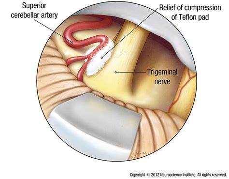 Trigeminal Neuralgia Surgery Specialists | Trigeminal Neuralgia Treatment