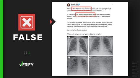 There Isnt A Mystery Pneumonia Called ‘white Lung Syndrome