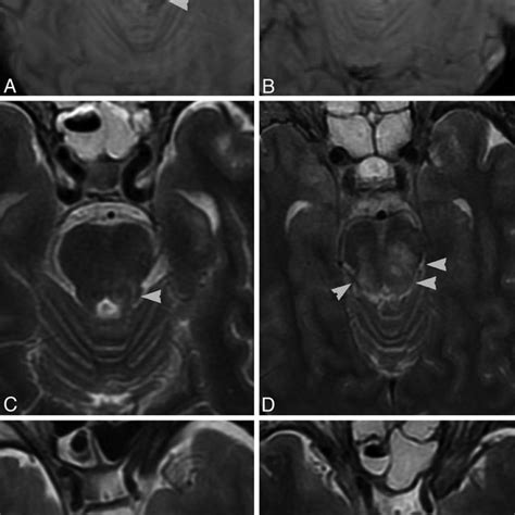 This Is Type 2 Brain Stem Injury Which Has Intraparenchymal Hemorrhage