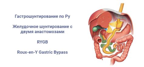 Гастрошунтирование по Ру — Про бариатрию хирург Бордан НС