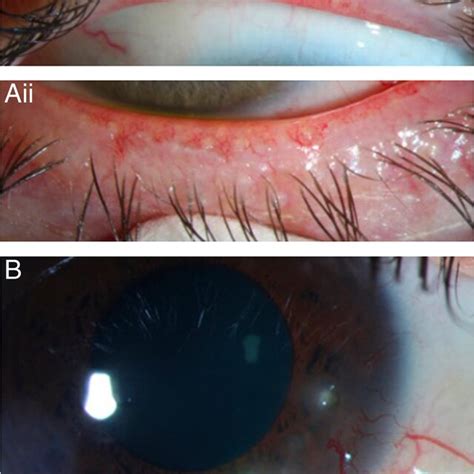 Clinical Examples Of Ocular Rosacea A Eyelid Margin Findings In A