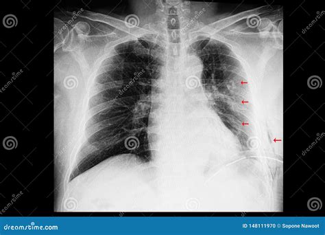 A Chest Xray Of A Patient With Rib Fractures And Pleural Effusion And