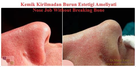 Health Zone Turkey Nose Tip Plasty Operation In Istanbul Turkey