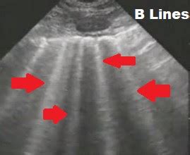 B-Lines Lung Ultrasound - Sumer's Radiology Blog