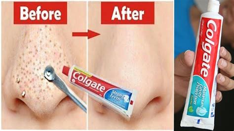 In Just 5 Mints Best Way To Remove Blackheads With Toothpaste Youtube