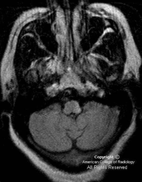 Neuroradiology On the Net: Lateral medullary syndrome (Wallenberg syndrome)