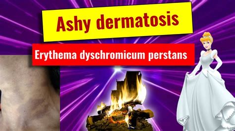 Ashy Dermatoses Erythema Dyschromicum Perstans Overview Features Histology Management Youtube