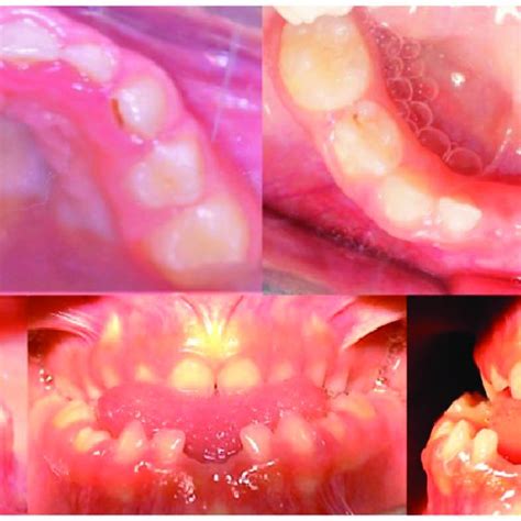 Most frequent oral mucosa lesions in children and adolescents.... | Download Scientific Diagram