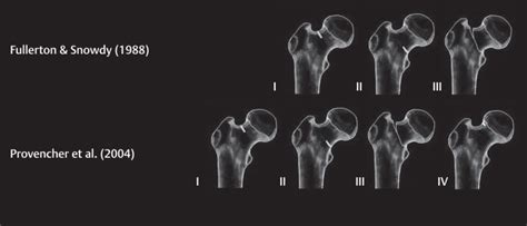 Femoral Neck Stress Fracture Wikimsk