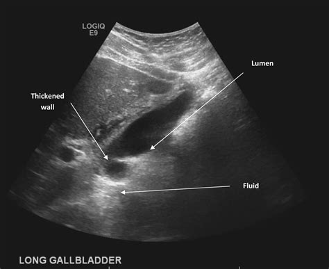 Hepatitis C Virus Associated Acalculous Cholecystitis And Review Of The Literature