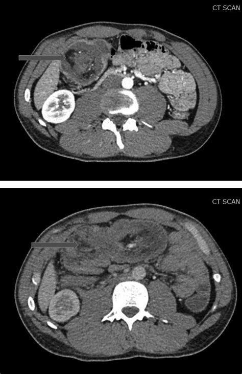 A Ileocecal Intussusception Blue Arrow Seen On Transverse Cut Of A Ct