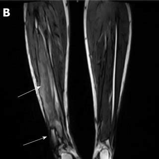 Imaging Examination Of The Right Calf A Anteroposterior X Ray Films