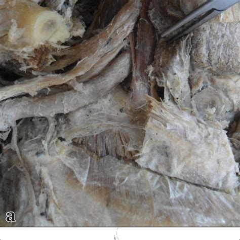 A Photo Of Dissected Neck Right Side B Explanatory Illustration Of